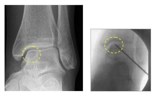 a vállízület blokkjának osteochondrosis